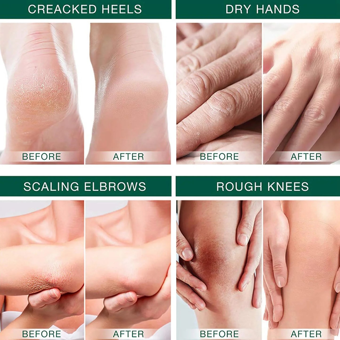 Urea Cream 42%, Foot Cream for Dry Cracked Heels, Moisturizing & Exfoliating Foot Cream 