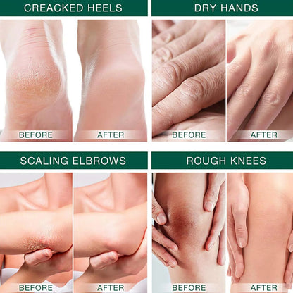 Urea Cream 42%, Foot Cream for Dry Cracked Heels, Moisturizing & Exfoliating Foot Cream 
